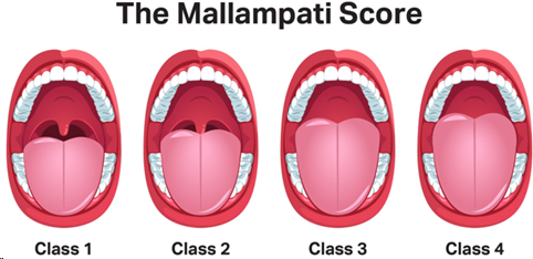 Illustration of the Mallampati Score