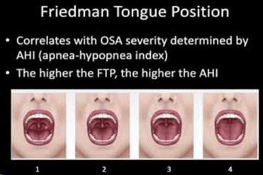 Illustration the Friedman Tongue Position