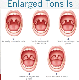 Showing Enlarged Tonsils