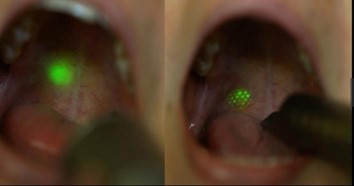 Where NightLase® Laser is applied