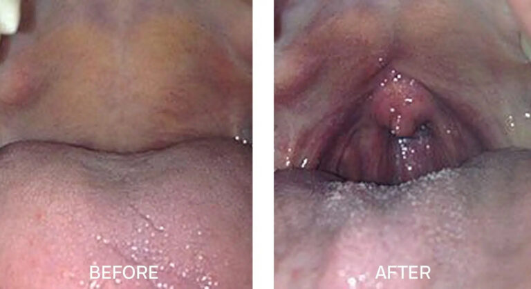 Before and After Image of patients mouth #5