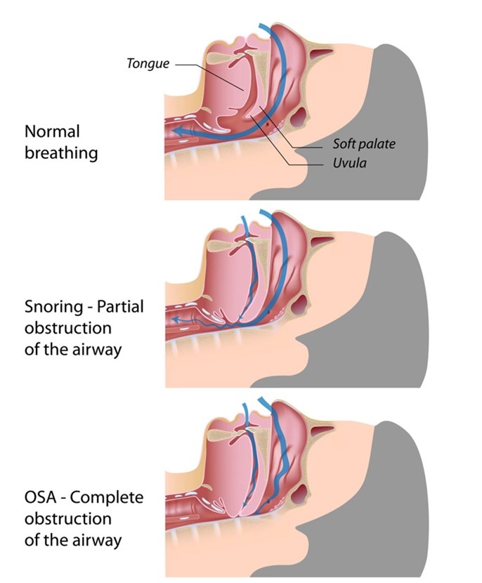Illustration from Normal Breathing, to snoring complete obstruction of the airway.